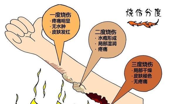 三度:Ⅲ度烫伤,深及皮下组织,局部皮肤会变白,发硬,甚至焦黑,干燥
